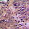 MDM2 Proto-Oncogene antibody, LS-C354039, Lifespan Biosciences, Immunohistochemistry paraffin image 