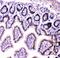 Heterogeneous Nuclear Ribonucleoprotein F antibody, A05806, Boster Biological Technology, Immunohistochemistry paraffin image 