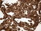 Thyroglobulin antibody, LS-C799258, Lifespan Biosciences, Immunohistochemistry paraffin image 