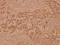 B-Raf Proto-Oncogene, Serine/Threonine Kinase antibody, A00075-1, Boster Biological Technology, Immunohistochemistry paraffin image 
