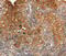 Plasminogen Activator, Urokinase Receptor antibody, MBS2524126, MyBioSource, Immunohistochemistry paraffin image 