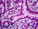 Protein Tyrosine Phosphatase Non-Receptor Type 22 antibody, LS-B5113, Lifespan Biosciences, Immunohistochemistry paraffin image 