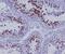 Hyaluronan Mediated Motility Receptor antibody, M05056, Boster Biological Technology, Immunohistochemistry paraffin image 