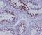 Hyaluronan mediated motility receptor antibody, M05056, Boster Biological Technology, Immunohistochemistry paraffin image 