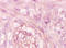 Mucin 1, Cell Surface Associated antibody, 251392, Abbiotec, Immunohistochemistry paraffin image 