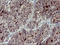 Matrix Metallopeptidase 13 antibody, LS-C338153, Lifespan Biosciences, Immunohistochemistry paraffin image 