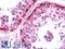 MAGE Family Member A3 antibody, LS-B10016, Lifespan Biosciences, Immunohistochemistry paraffin image 