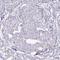 ERBB2 antibody, AMAb90627, Atlas Antibodies, Immunohistochemistry paraffin image 