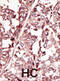 ROS Proto-Oncogene 1, Receptor Tyrosine Kinase antibody, abx033607, Abbexa, Immunohistochemistry paraffin image 