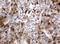 Thymidine Phosphorylase antibody, M06329-1, Boster Biological Technology, Immunohistochemistry paraffin image 