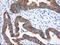 Insulin Like Growth Factor 2 MRNA Binding Protein 2 antibody, LS-C115285, Lifespan Biosciences, Immunohistochemistry paraffin image 