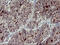 Matrix Metallopeptidase 13 antibody, LS-C797730, Lifespan Biosciences, Immunohistochemistry paraffin image 