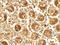 Apolipoprotein B MRNA Editing Enzyme Catalytic Subunit 3B antibody, A01088, Boster Biological Technology, Immunohistochemistry paraffin image 