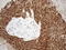 O-6-Methylguanine-DNA Methyltransferase antibody, LS-C794740, Lifespan Biosciences, Immunohistochemistry paraffin image 