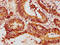 Matrix Metallopeptidase 13 antibody, LS-C285778, Lifespan Biosciences, Immunohistochemistry paraffin image 