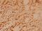 BRCA2 DNA Repair Associated antibody, A00009, Boster Biological Technology, Immunohistochemistry paraffin image 