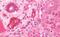 Interleukin 3 Receptor Subunit Alpha antibody, MBS249024, MyBioSource, Immunohistochemistry paraffin image 