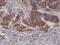 Cyclin-dependent kinase inhibitor 2A, isoforms 1/2/3 antibody, M00016-1, Boster Biological Technology, Immunohistochemistry paraffin image 
