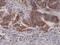 p16-INK4 antibody, M00016-1, Boster Biological Technology, Immunohistochemistry paraffin image 