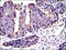 CRK Proto-Oncogene, Adaptor Protein antibody, M02533-1, Boster Biological Technology, Immunohistochemistry paraffin image 