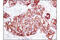 ERBB2 antibody, 4290, Cell Signaling Technology, Immunohistochemistry paraffin image 