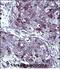 Thymidylate Synthetase antibody, A04320-3, Boster Biological Technology, Immunohistochemistry paraffin image 