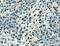 Zinc finger E-box-binding homeobox 1 antibody, 66279-1-Ig, Proteintech Group, Immunohistochemistry paraffin image 