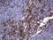 Mesothelin antibody, LS-C339487, Lifespan Biosciences, Immunohistochemistry paraffin image 
