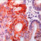 Mucin 16, Cell Surface Associated antibody, LS-C88415, Lifespan Biosciences, Immunohistochemistry paraffin image 