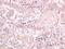 MHC Class I Polypeptide-Related Sequence B antibody, orb1241, Biorbyt, Immunohistochemistry paraffin image 