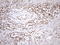 O-6-Methylguanine-DNA Methyltransferase antibody, LS-C798646, Lifespan Biosciences, Immunohistochemistry paraffin image 