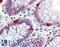 Hepatocellular carcinoma-associated protein TD26 homolog antibody, LS-B15035, Lifespan Biosciences, Immunohistochemistry paraffin image 