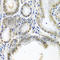Protein SSX2 antibody, A6989, ABclonal Technology, Immunohistochemistry paraffin image 